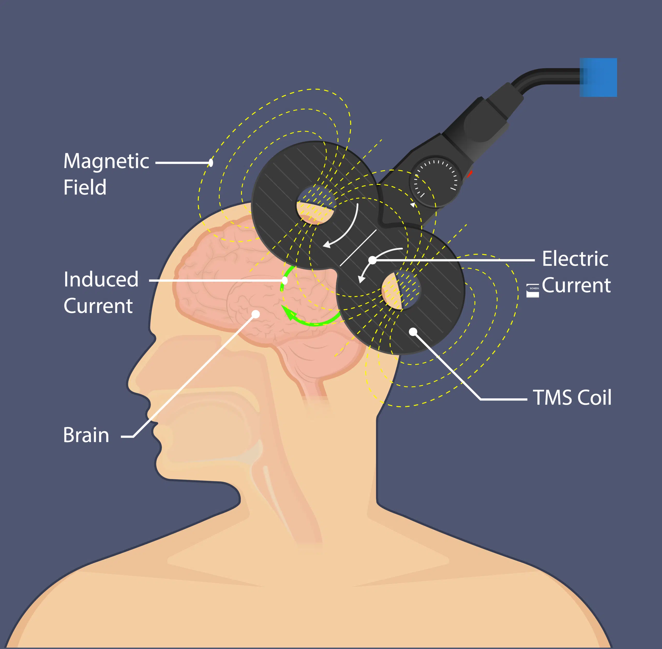 TMS-how-it-works